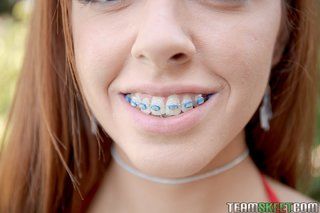 Master recommendet braces teeth gallery naked on teens