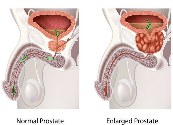 Prostate throat